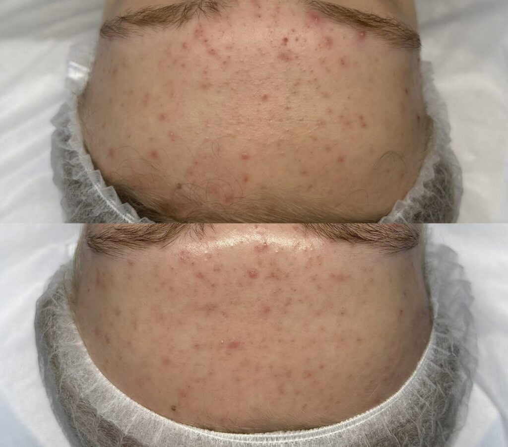 Efekty terapii skóry trądzikowej po jednym zabiegu – Veritas Derm
